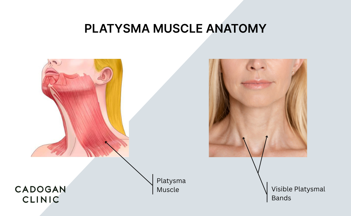 An infographic showing the location of the platysma muscle, and how platysmal bands display in the nek